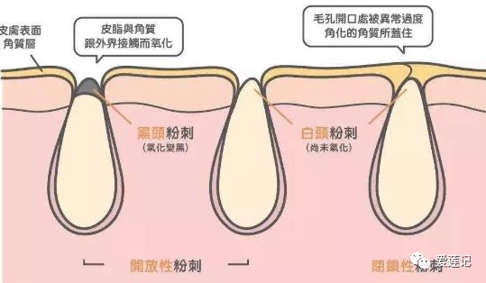 黑头挤不掉怎么办,棉签挤白头黑头