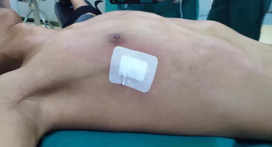 14岁男孩因“漏斗胸”自卑想退学，这是种什么病？