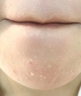 解决闭口最佳方法不复发,如何去闭口最有效方法