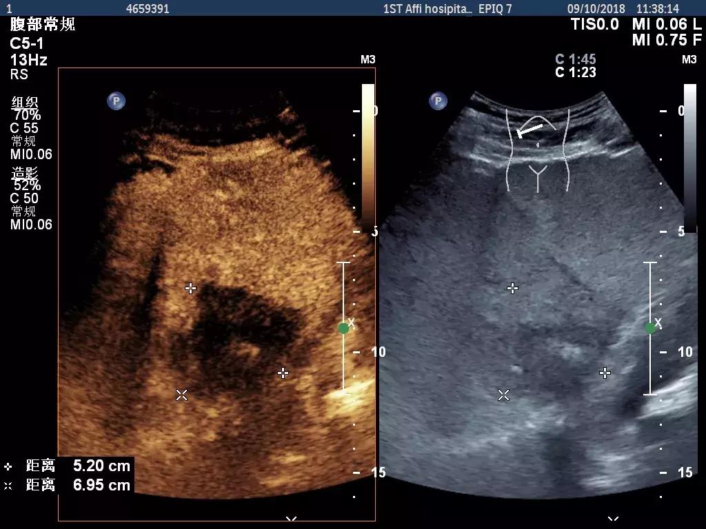 肝癌粒子植入和消融哪个好,肿瘤微波消融