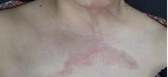 打耳洞耳朵增生,只要打耳洞就会耳洞增生