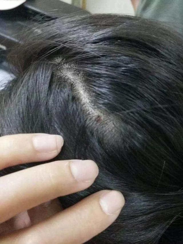 4岁女童头老是痒,4岁女童老是头痒