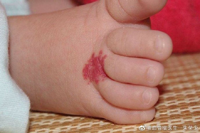 脑干海绵状血管瘤应该注意什么,脑海绵状血管瘤手术后注意事项