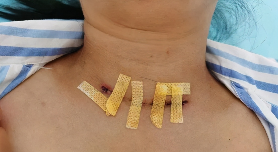 甲状腺结节癌手术后最忌讳什么,甲癌术后发现多发肺结节要观察吗