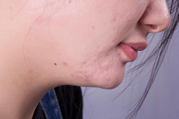 抿嘴时下巴密密麻麻小疙瘩,下巴一抿嘴有个白色疙瘩
