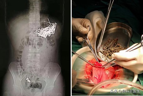 为什么会把异物塞进尿道,为什么会有人往尿道里塞异物