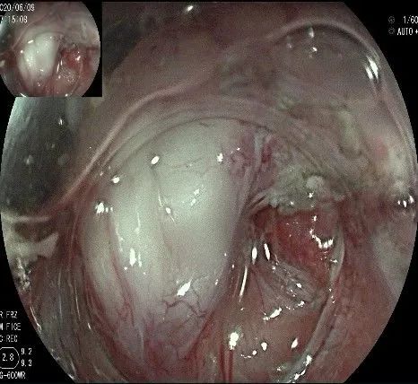 贲门处见隆起性病变,贲门高级别瘤变esd术后不能吃什么