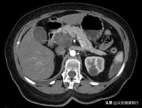 JPathol：追踪肿瘤疤痕组织有望彻底根治胰腺癌