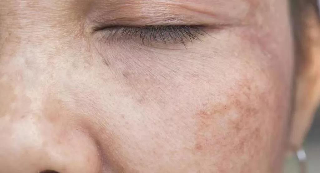 去褐斑最有效的偏方,褐斑的最佳治疗方法