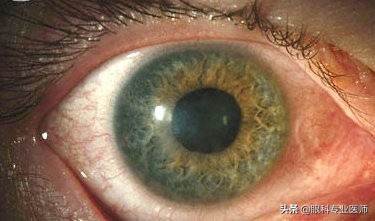 流行性角结膜炎的致病菌,流行性角结膜炎的体征