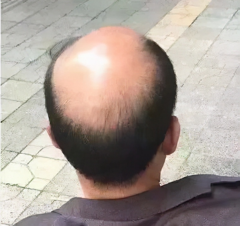 我国2.5亿人“秃了”,科学家找到“元凶”后反而更苦恼,咋回事