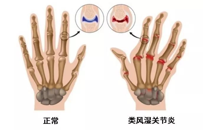 治疗类风湿性关节炎进口新药,类风湿性关节炎新药有哪些