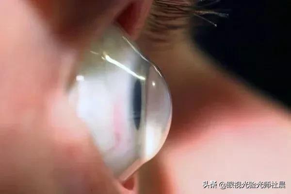 近视手术的几种方式优缺点对比图,近视800到900适合做什么近视手术