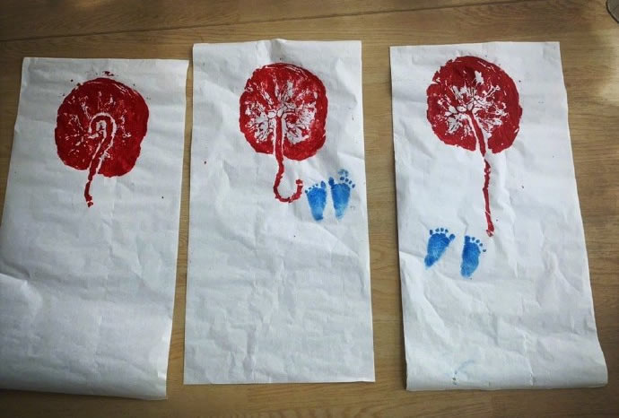 谢依霖后遗症有哪些表现,谢依霖晒孕照大量妊娠纹吓坏观众