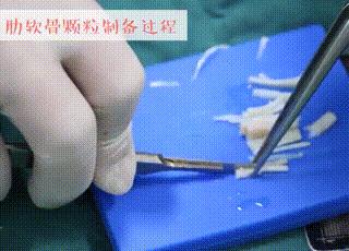 想做隆鼻的女孩,肋软骨填充鼻基底会拉长人中吗