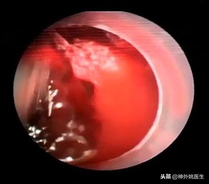 球囊扩张血肿怎么办,神经内镜辅助脑内血肿清除