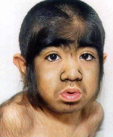 西班牙多名儿童服用来自印度的问题药物，患狼人多毛症似猴孩