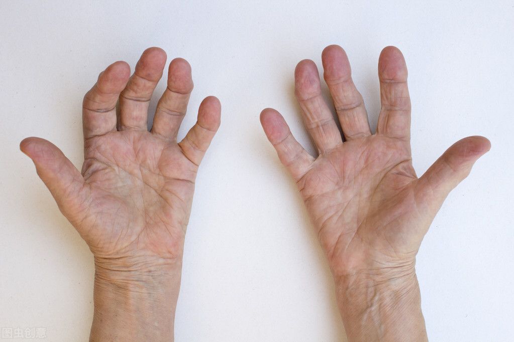 风湿关节痹痛可以治好吗,类风湿热痹的最佳中成药