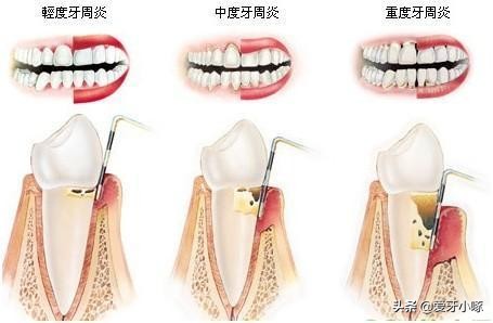 牙周病不能治好的吗,牙周病不治疗后果