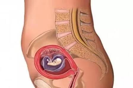 子宫里边长痘影响生育吗,子宫内膜囊肿会影响试管着床吗