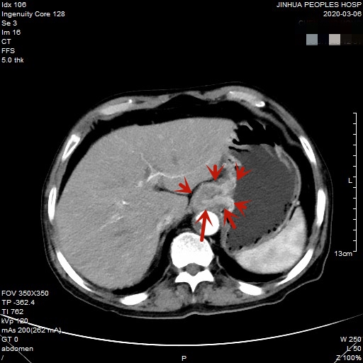 贲门癌80岁手术好还是保守治疗好,医生建议80岁老人做贲门癌手术