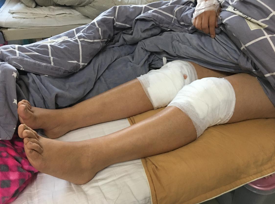 针灸感染,河南诊所针灸感染