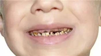 五岁孩子喝可乐,孩子喝可乐牙齿发黑