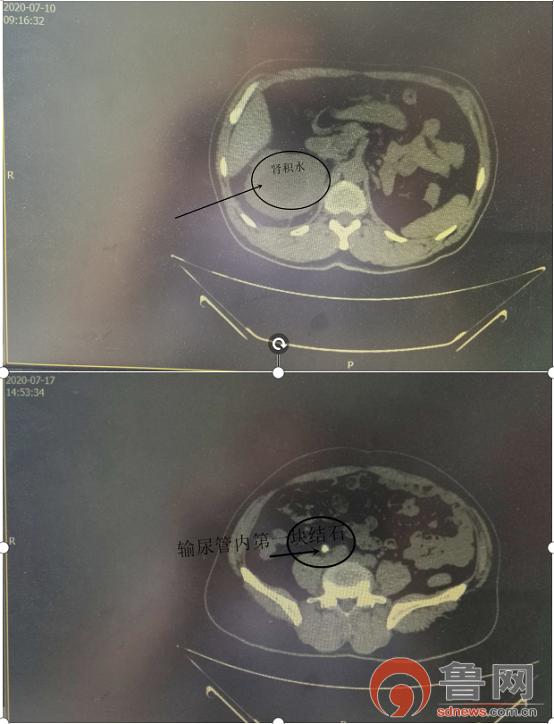 先天性独肾得了肾结石怎么治疗好,孤立肾多发肾结石要及时治疗吗