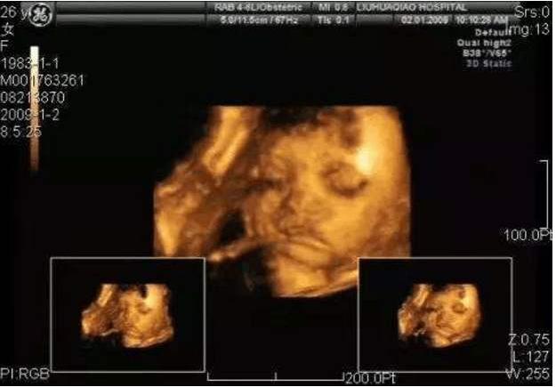 四维彩超大揭秘：怀孕了，你做四维彩超检查了吗？