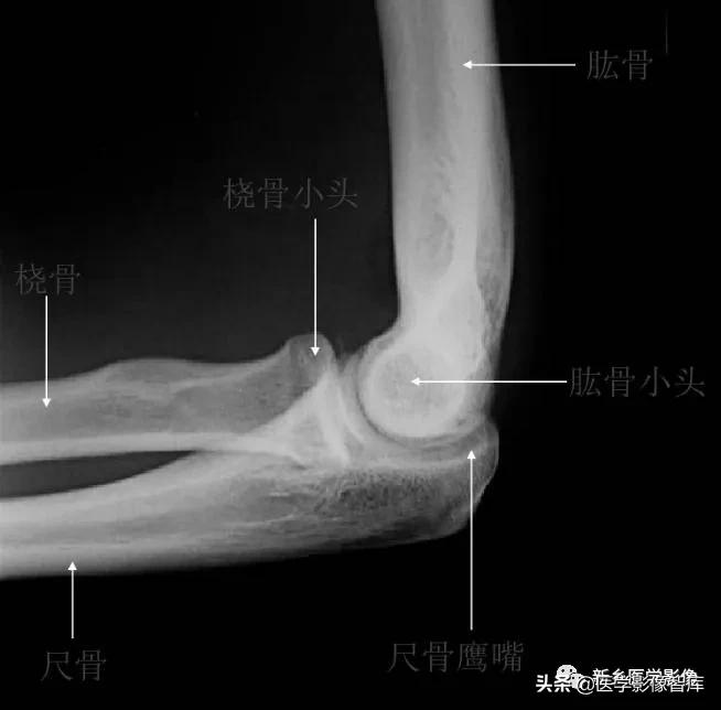 肘关节x线测量,肘关节骨骺示意图