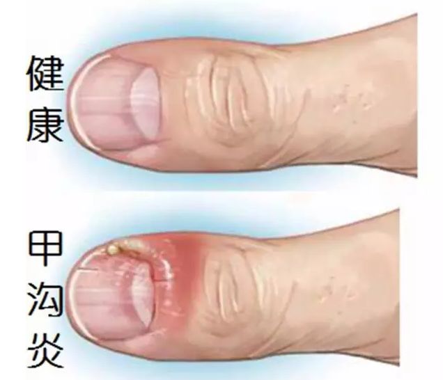 跑步跑出黑指甲怎么处理,跑步后脚趾甲充血变黑怎么办