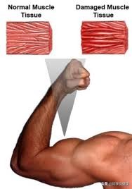 运动完第二天浑身痛怎么快速恢复,运动后乳酸堆积肌肉酸痛怎么缓解