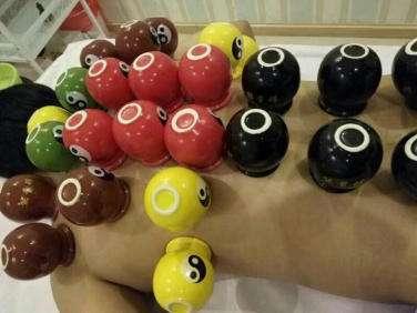 拔罐的好处那么多还要注意哪些