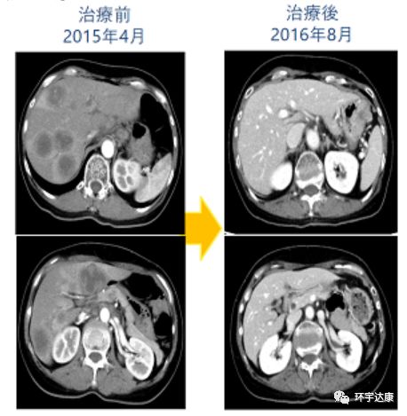 世界上完全可以预防的癌症疫苗,未来10年癌症有可能被攻克吗