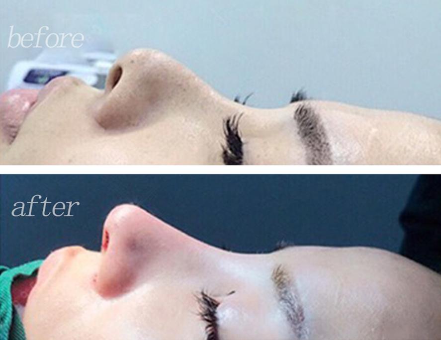 隆鼻对皮肤有什么影响,隆鼻对颜值有多大影响