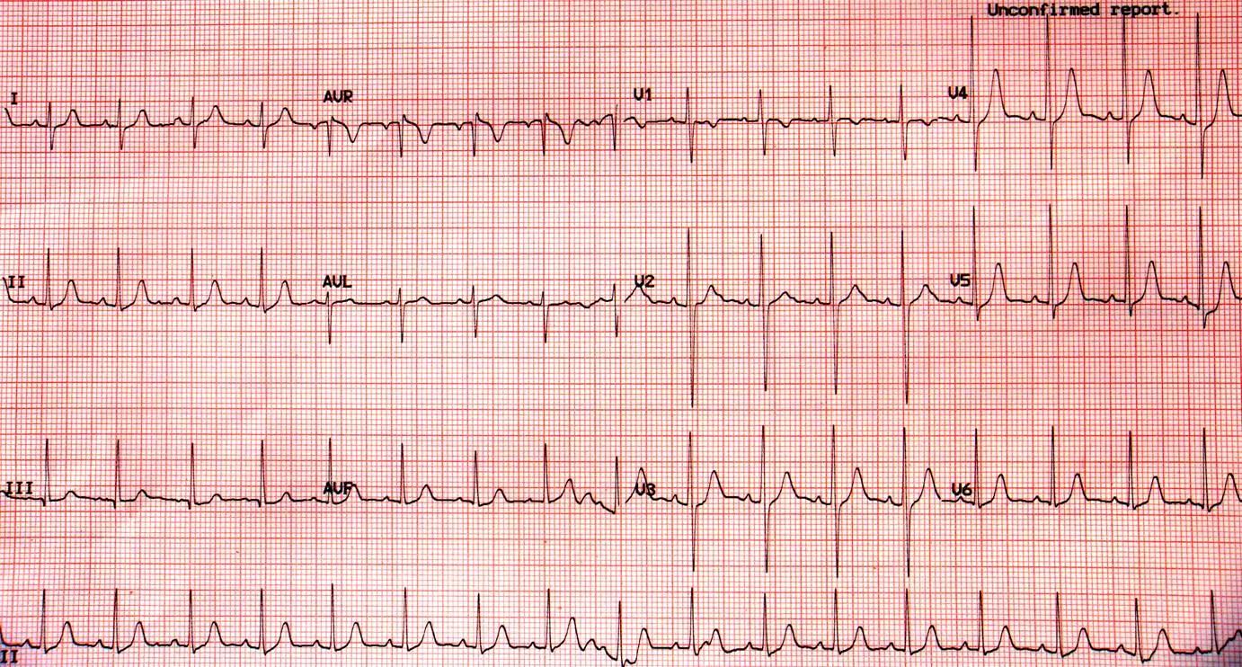 儿童阵发性室上心动过速,儿童阵发性室上性心动过速
