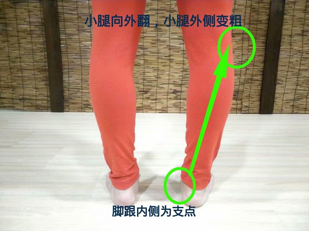 扁平足的腿型怎么改善,扁平足导致腿粗怎么办