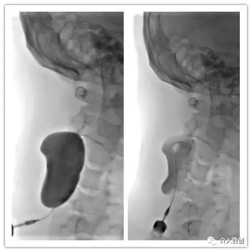 淋巴管畸形硬化治疗费用,静脉畸形硬化的最佳治疗方法