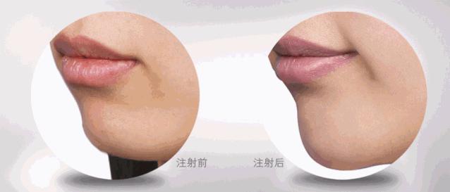 玻尿酸丰下巴有危害吗,玻尿酸隆下巴的危害