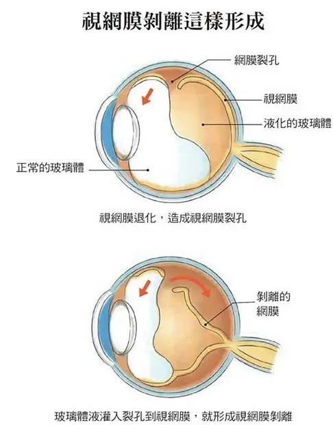 眼前有黑影之飞蚊症