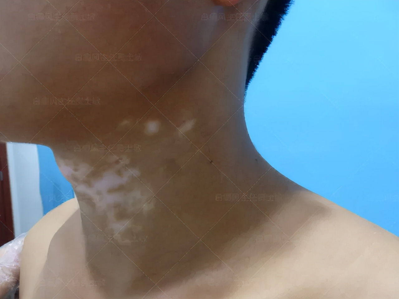 18岁男孩高考备战,18岁男孩白斑