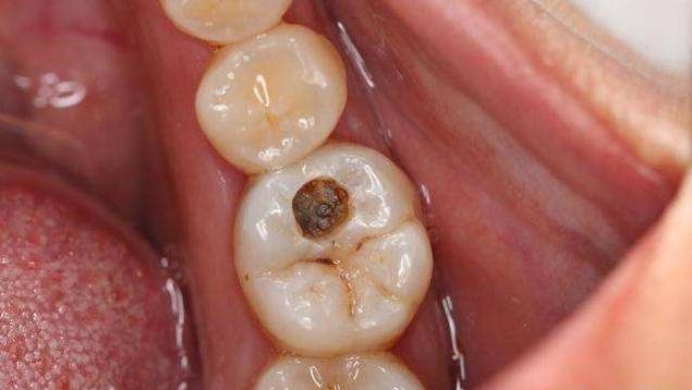 牙齿有黑线就证明里面坏了吗,牙齿有黑渍一定是龋齿吗