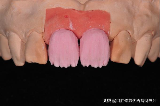 展评优秀病例赏析|Asc全瓷角度基台一体冠进行种植前牙美学修复