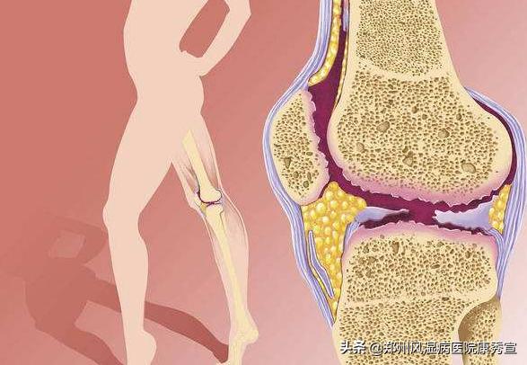 类风湿性关节炎致病因素分析,类风湿病因最新研究