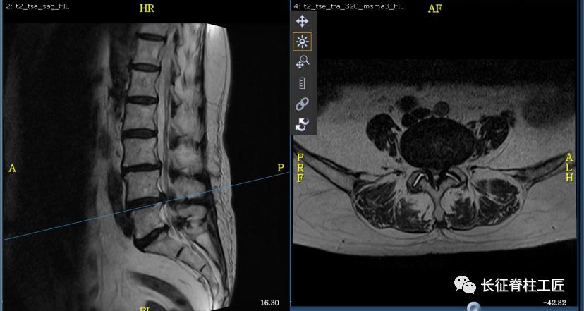 老年人腰椎管狭窄可以微创手术吗,老年人腰椎管狭窄瘫痪