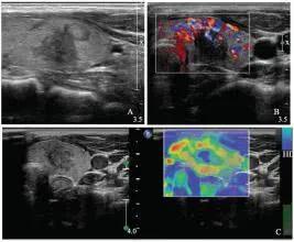 甲状腺彩超结节无包膜是什么意思,甲状腺结节有几个低回声代表什么