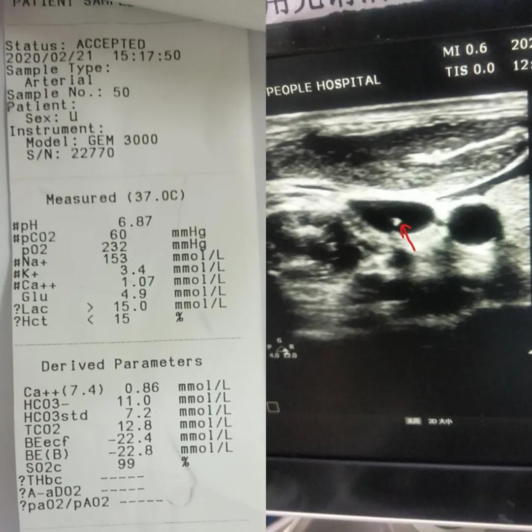 极度贫血的后果,极度贫血会带来什么后果