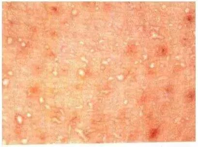 痱子粉止痒儿童,孩子起痱子用痱子粉管用吗