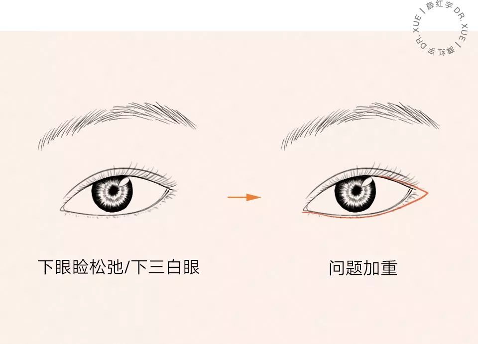 要不要开下眼睑,要不要开内眦赘皮