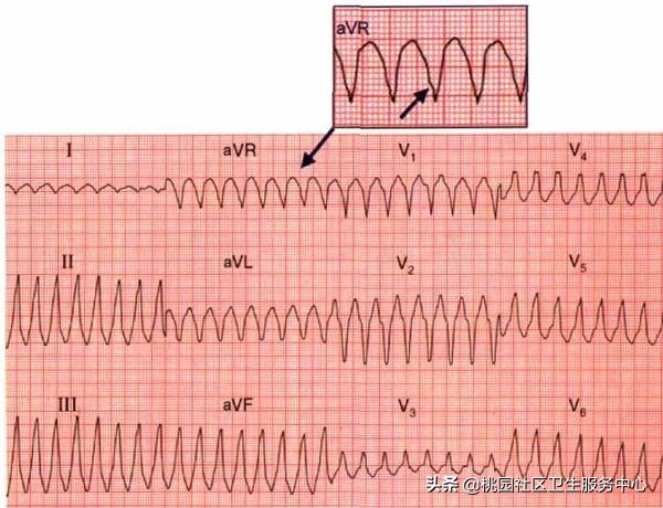 心电图危险指数两颗星,高危心电图的识别